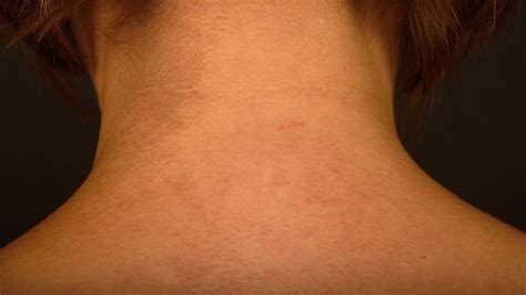 Mild Acanthosis Nigricans Neck