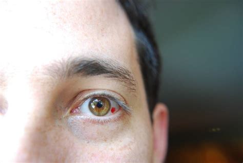 Красное пятно в глазу: причины и методы лечения oculistic.ru