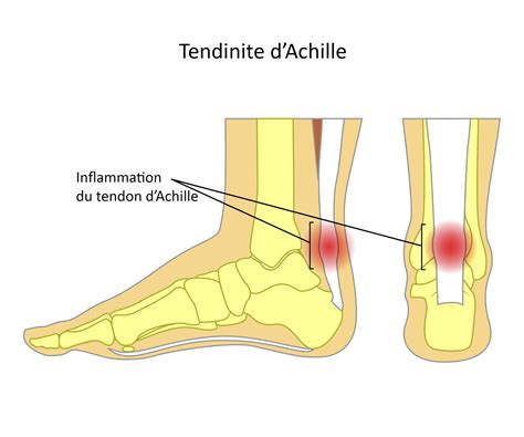 Le Louedec Tendinopathies Dachille