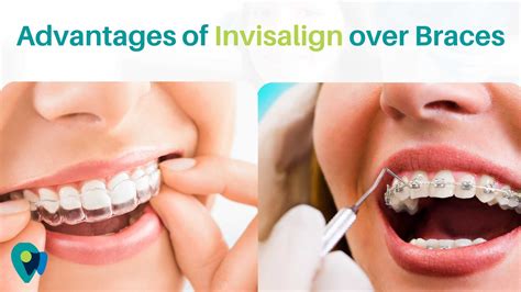 Advantages Of Invisalign Over Braces 9310603593