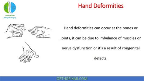 Hand Deformities | OrthoFixar 2025