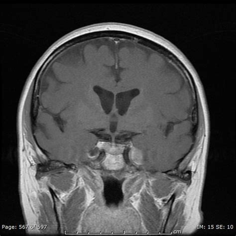 Meckels Cave Mri Anatomy