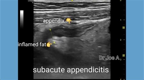 Subacute Appendicitis With Perforation Ultrasound And Color Doppler