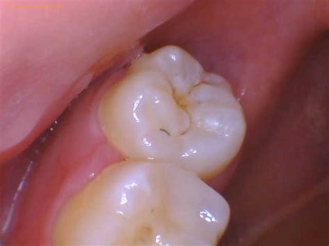 Black Spot On Tooth Guide Jackson Ave Dental Dentist In Long