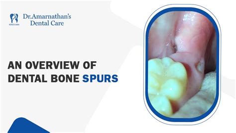 An Overview Of Dental Bone Spurs