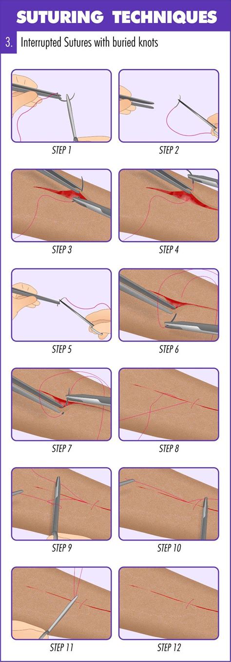 Nursing Tips Nursing Study Nursing Programs Suture Techniques