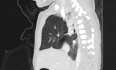 Congenital Lobar Emphysema Image Radiopaedia Org