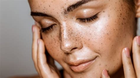 Taches de rousseur et taches d hyperpigmentation Faut il les apprécier