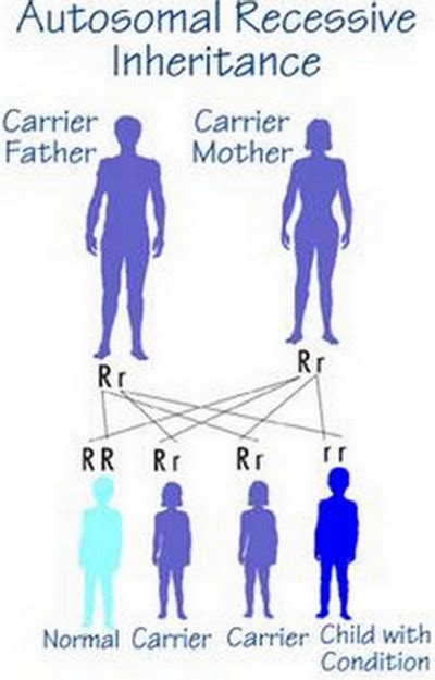 Hurler Syndrome Pictures Diagnosis Treatment And Prognosis