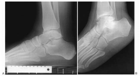 Degenerative Joint Disease Of The Ankle And Hindfoot Musculoskeletal Key