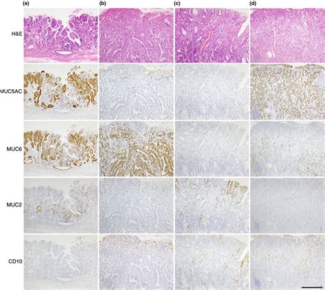 Mucin Expression In Gastric Cancer A Muc5ac Muc6 And