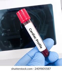 Blood Sample Cardiac Profile Test Cpk Stock Photo 2409805587 Shutterstock