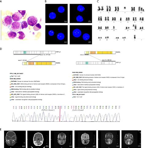 Acute Promyelocytic Leukemia Atra