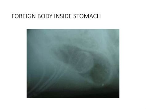 Surgical Extraction Of Gastric Foreign Body Ppt