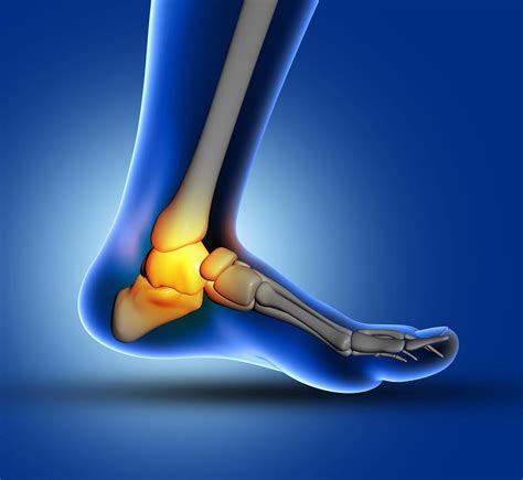 Plantar fasciitis Treatment in Fairfax, VA and Potomac, MD | SAPNA ...