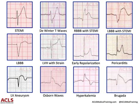 Ekg Cheat Sheet Acls Study Emt Study Paramedic School Emt Paramedic