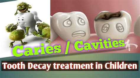 Tooth Decay in children | Prevention of Dental Caries in Children ...