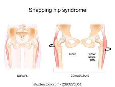 Snapping Hip Syndrome Coxa Saltans Iliopsoas Stock Vector Royalty Free