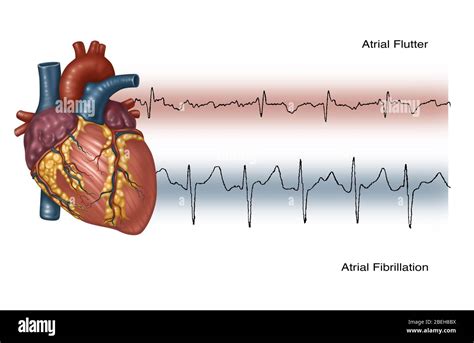 Flutter Atriale Ekg Immagini Senza Sfondo E Foto Stock Ritagliate Alamy