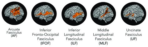 White Matter Tracts Of Interest Overlaid On Three Dimensional