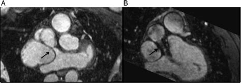 Percutaneous Recanalization Of Systemic Venous Baffle Occlusion After