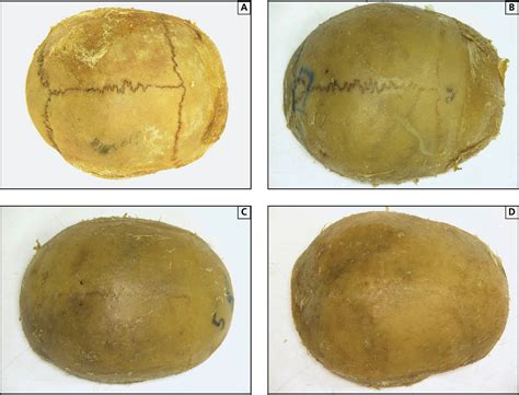 Figure 3 From Significance Of Differences In Patency Among Cranial