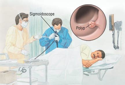 Sigmoidoscopy Procedure