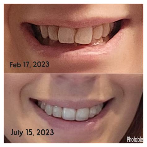 6 Months Progress R Invisalign