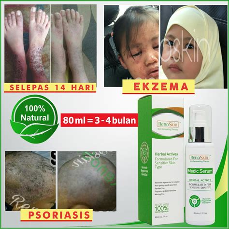 Natural Serum Ubat Krim Merawat Penawar Ekzema Psoriasis Masalah