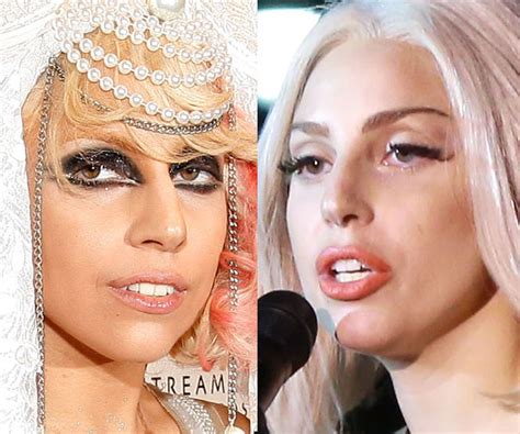 Lady Gaga Nose Job Surgery Before And After Photos