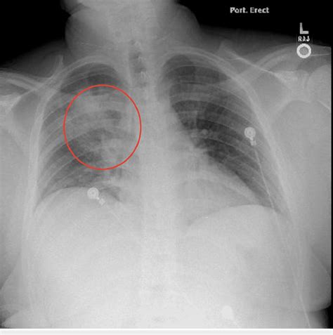 Chest X Ray Showing Multiple Opacities In The Right Lung Download Scientific Diagram