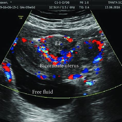 Laparotomy With Bicornuate Uterus And Site Of Ectopic Pregnancy Arrow Download Scientific Diagram