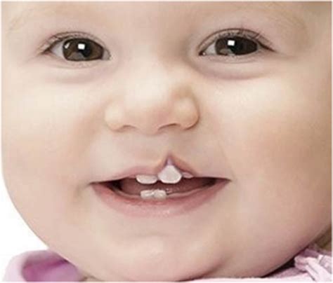 All About Cleft Lip And Palate What You Should Expect And Know