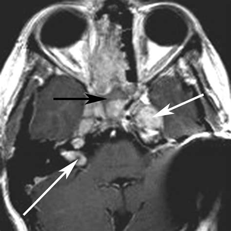 Sphenoid Sinus Tumours