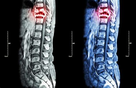 Complications Arising From Paralysis Due to Spinal Cord Injuries