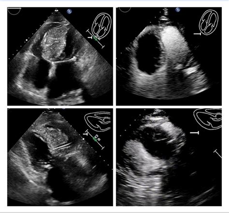 Giant Interventricular Septal Hematoma Complicating Left Bundle Branch