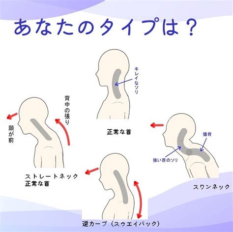 【2023年】ストレートネックの治療 前橋市の整骨院なら前橋アイメディカル鍼灸整骨院