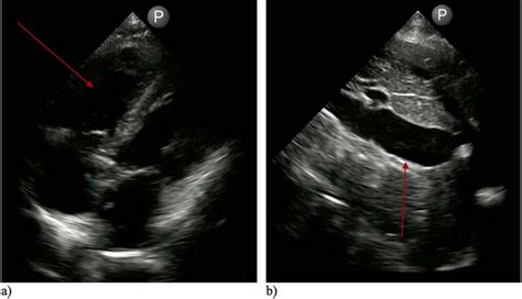 A Near Miss Subclinical Saddle Pulmonary Embolism Diagnosed By Handheld Ultrasound Oxford