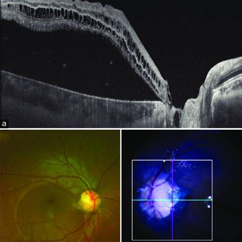 Pdf Optic Disc Pit Maculopathy And Its Spectrum Of Management