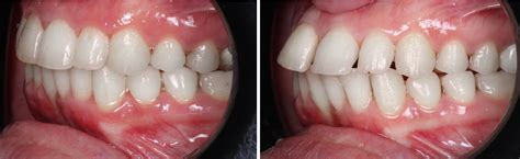 Class Ii Malocclusion With Clear Aligners How To Successfully Treat Your Patients