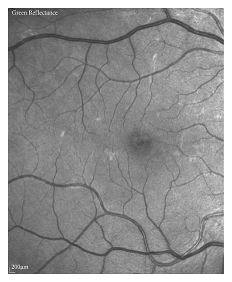 Multimodal Imaging Of Lamellar Macular Hole A Structural Optical