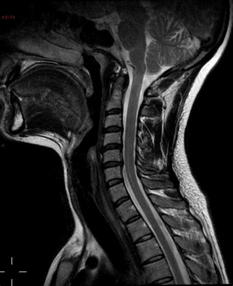 irm moelle cervicale irm cervicale déroulement TURJN