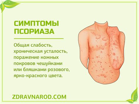 Псориаз | Народная медицина