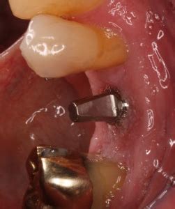 Previous Gum Disease Dental Implants Ryan Lanman Dds Msd