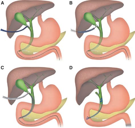 Ercp Stent