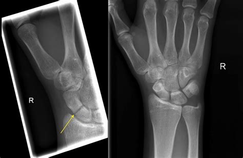 Scaphoid Fracture Radiology At St Vincents University Hospital