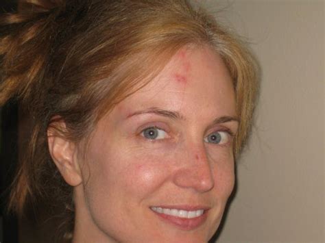 Shingles on Face – Causes, Signs and Treatment | Shingles Expert