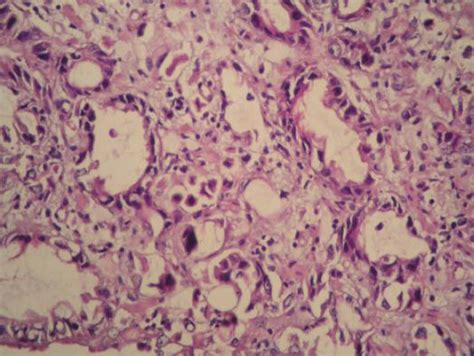 Histologic Examination Of The Resected Specimens With Hematoxylin And