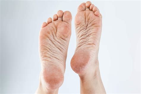 3 Cremas Naturales Para Eliminar Los Callos De Los Pies Mejor Con Salud