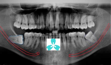 Horizontally Impacted Wisdom Teeth Removal